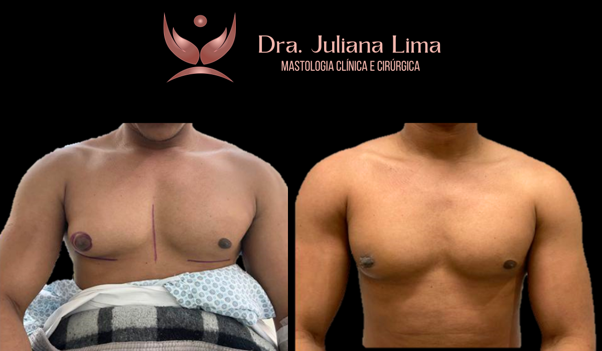 You are currently viewing Correção de Ginecomastia unilateral