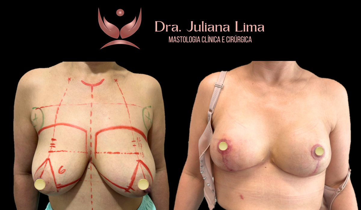 Read more about the article Mastectomia bilateral e reconstrução imediata com prótese – BCRA 2 mutada