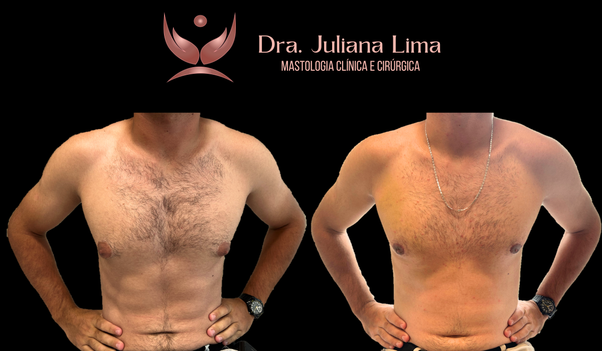 Read more about the article Correção de Ginecomastia bilateral