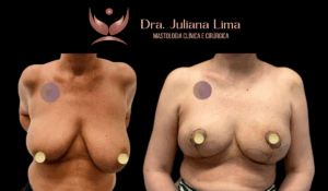 Read more about the article Mastopexia associada a tratamento do câncer de mama