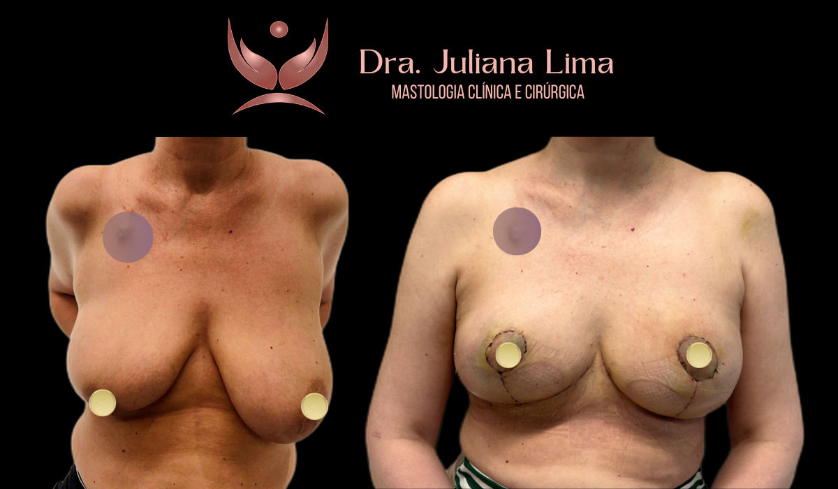 Read more about the article Mastopexia associada a tratamento do câncer de mama