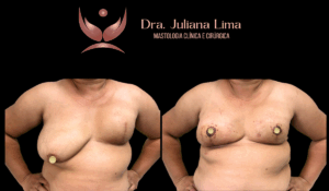 Read more about the article Simetrização Mamária pós mastectomia