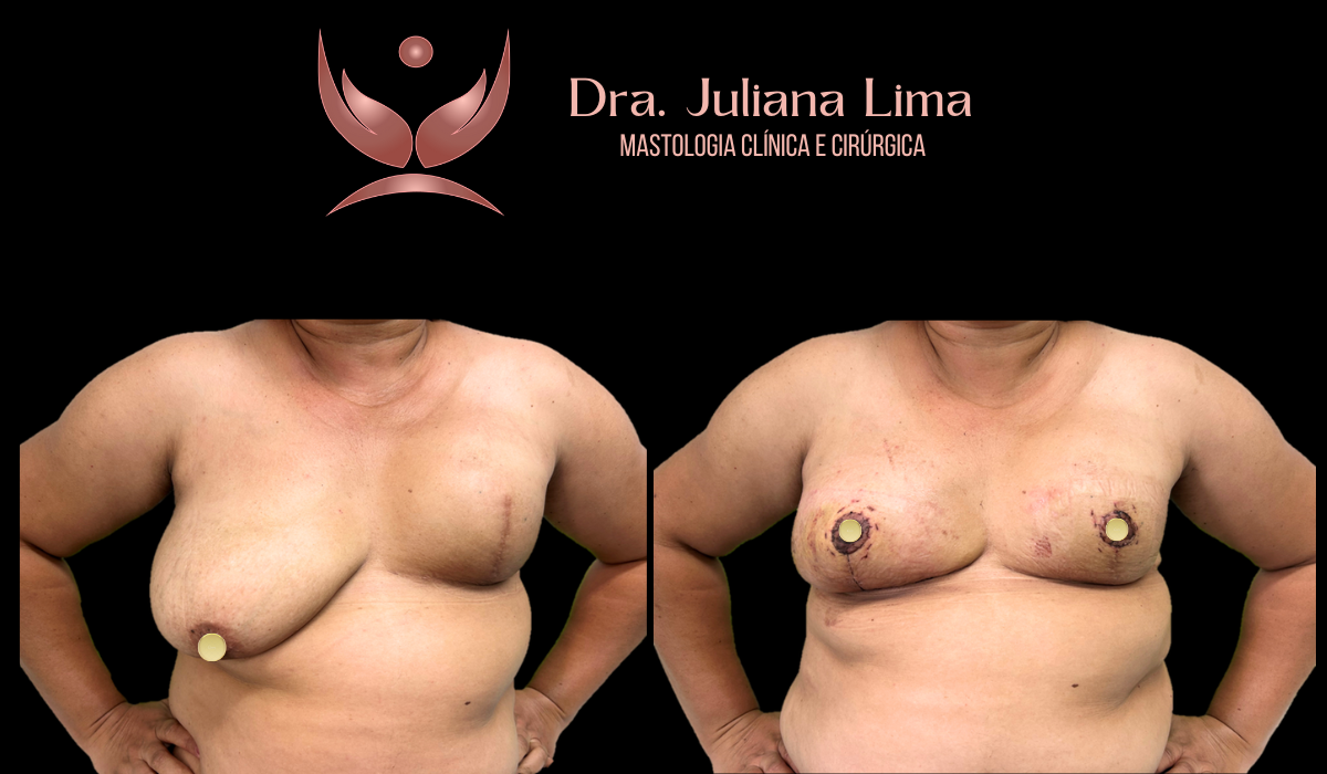 Read more about the article Simetrização Mamária pós mastectomia