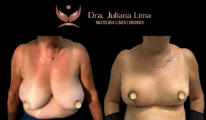 Read more about the article Mastopexia associado a tratamento do câncer de mama